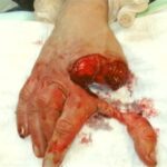 Chainsaw Accidents And Suffering The Consequences