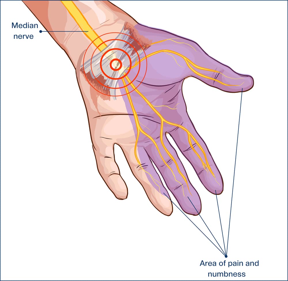 Carpal Tunnel Syndrome