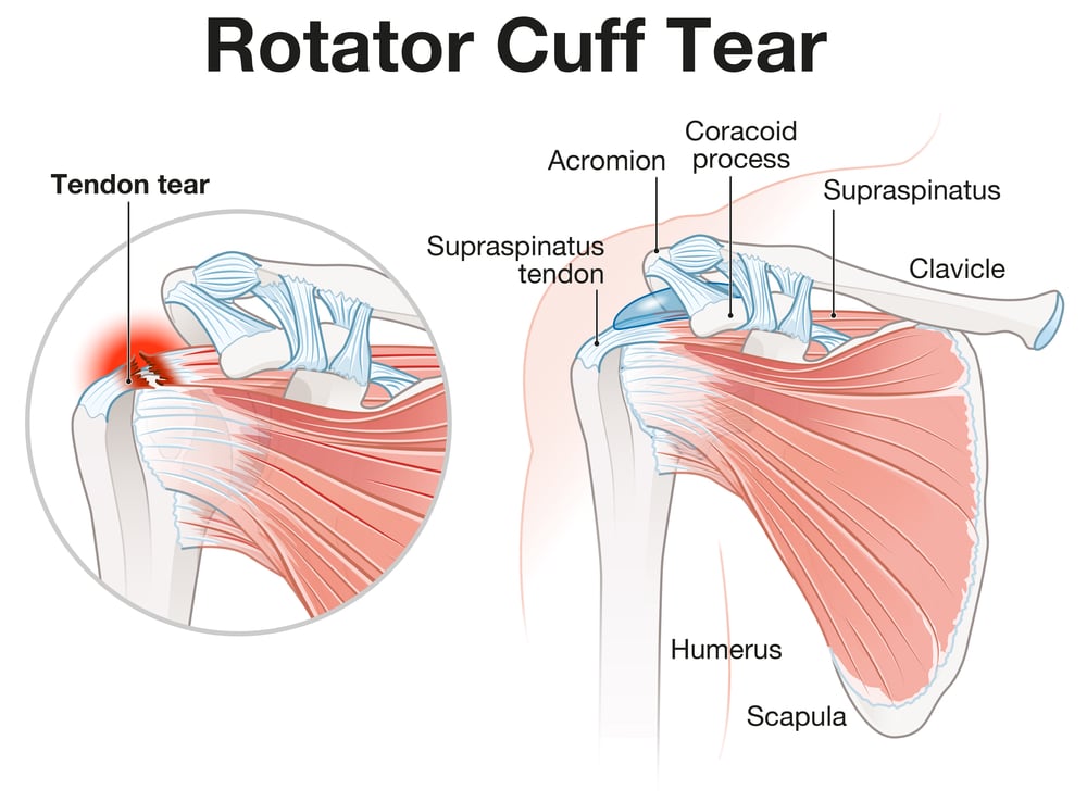 Rotator Cuff Tear