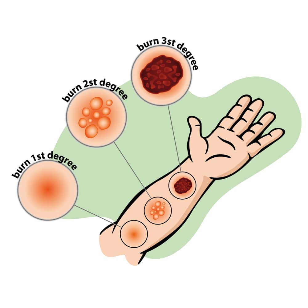 An arm which shows the difference between 1st, 2nd and 3rd degree burns following an electrical burn.